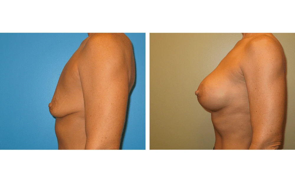 Breast augmentation before and after, side profile view demonstrating improved contour