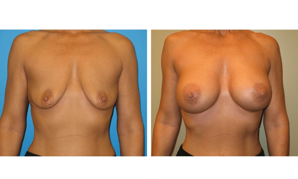 Breast augmentation before and after, front view showing symmetric fullness and lift
