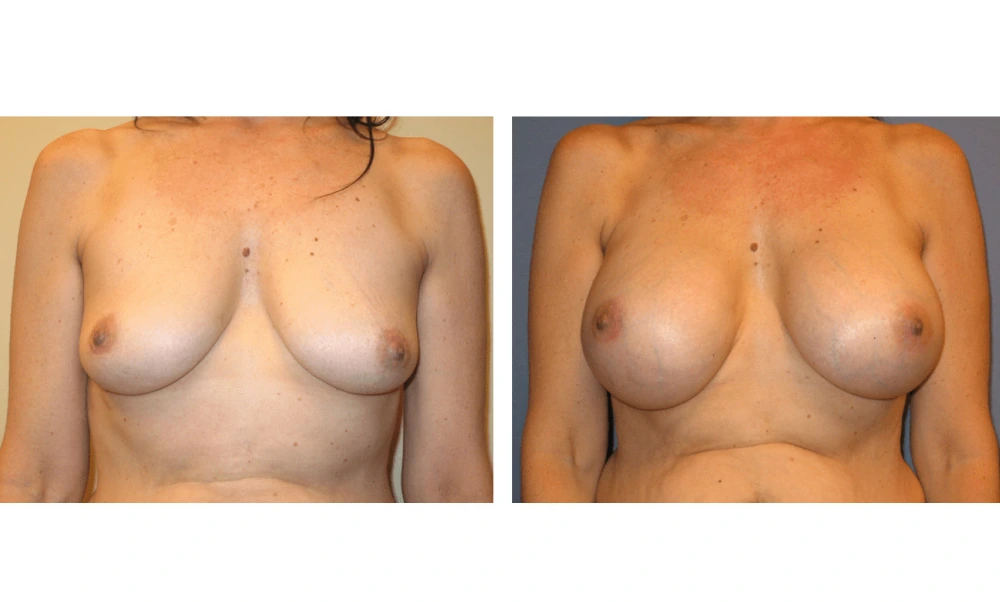 Breast Augmentation - Case 2