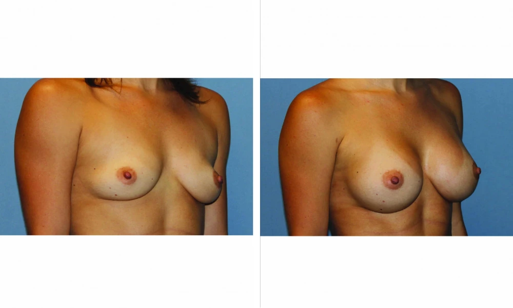 Breast augmentation before and after comparison, angled front view, demonstrating increased volume and refined contours