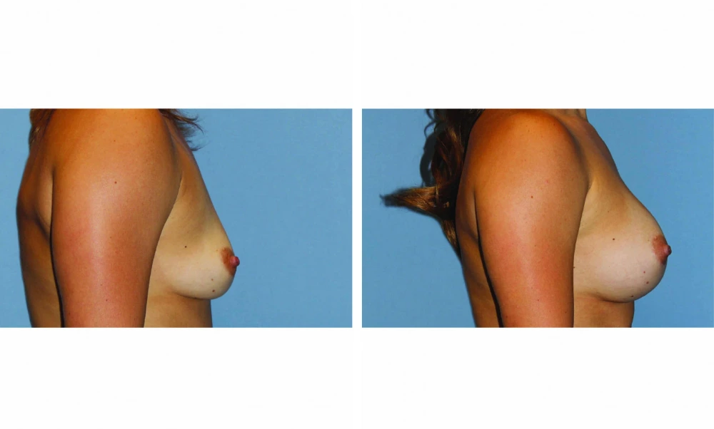 Breast augmentation before and after, side view showing increased volume and projection
