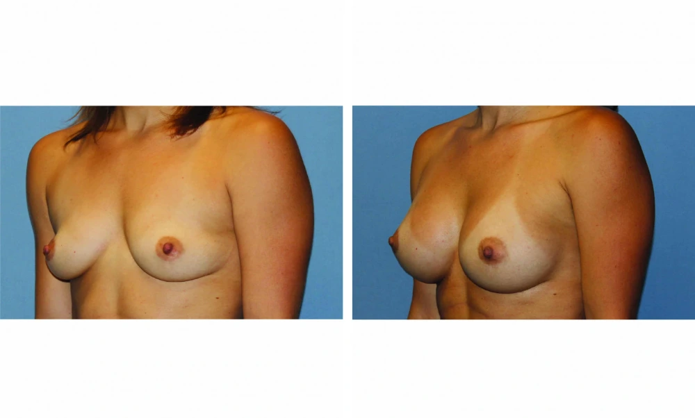 Breast augmentation before and after, frontal view showing enhanced fullness and symmetry