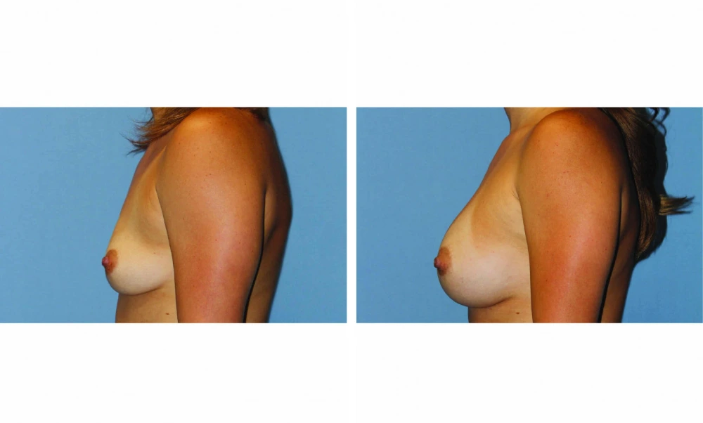 Breast augmentation before and after, oblique side view demonstrating improved contour