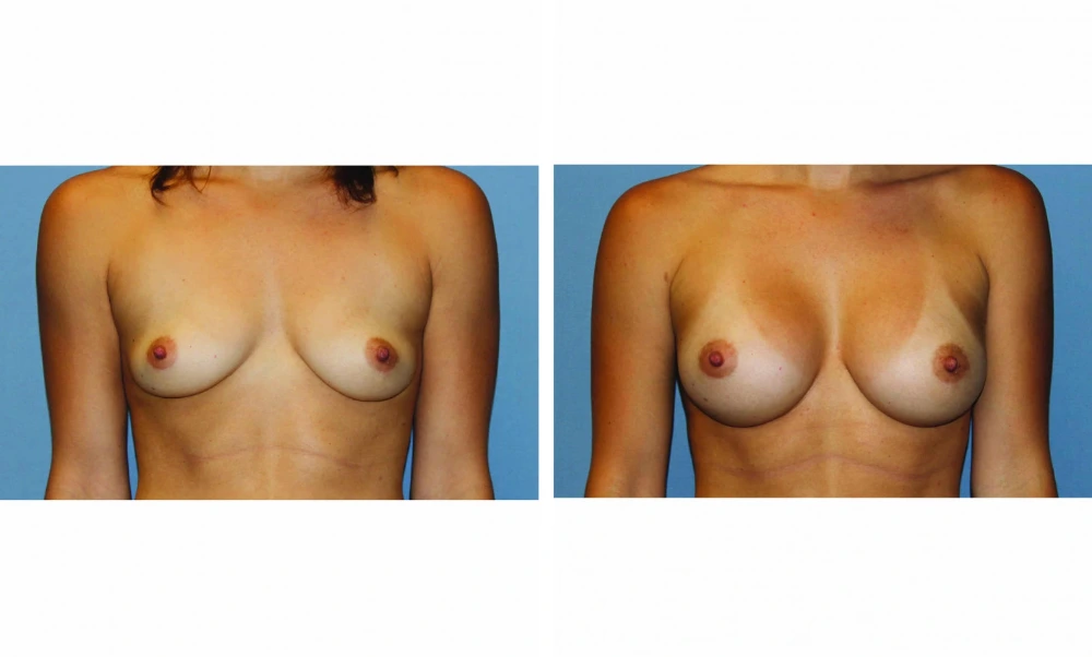 Breast augmentation before and after comparison, front-facing view, showing fuller breast appearance and enhanced shape