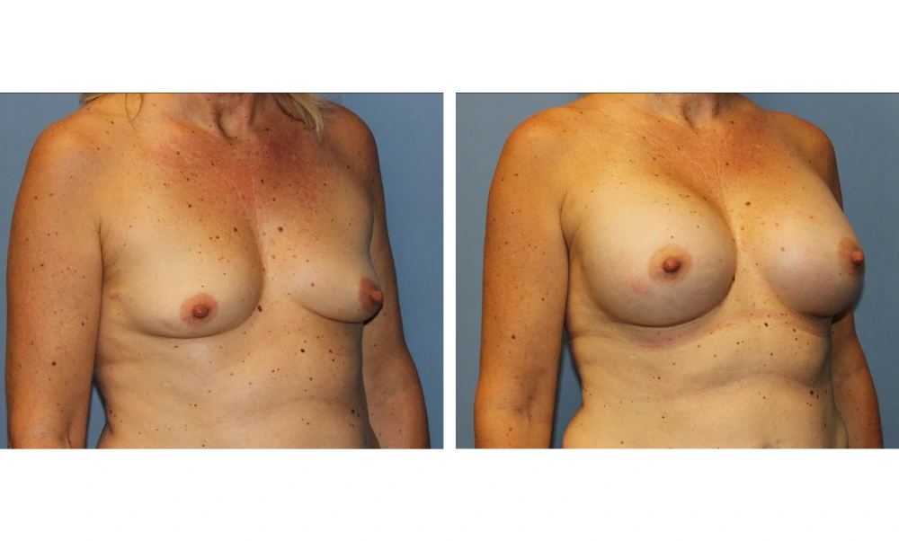 Breast augmentation before and after, frontal view displaying balanced proportions and lift