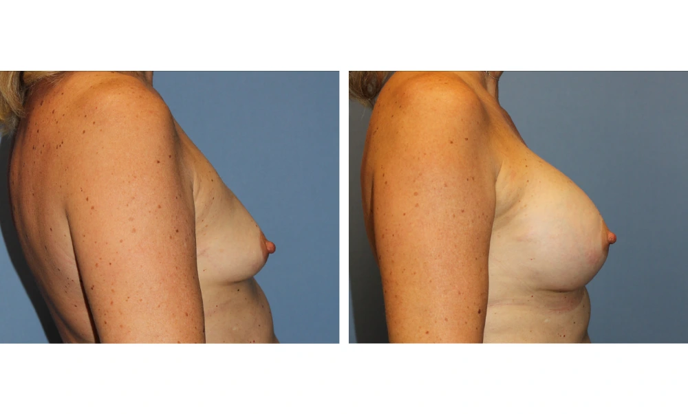 Breast augmentation before and after, side profile view