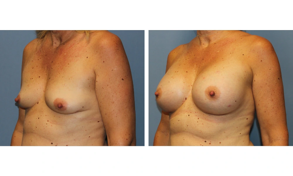 Breast augmentation before and after, front-facing view