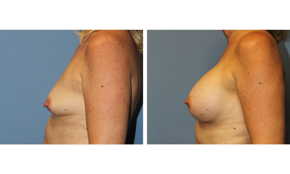 Breast augmentation before and after, side profile showing natural-looking enhancement