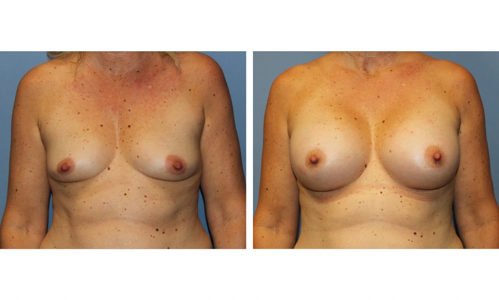 Breast augmentation before and after, frontal view with improved shape and upper pole fullness