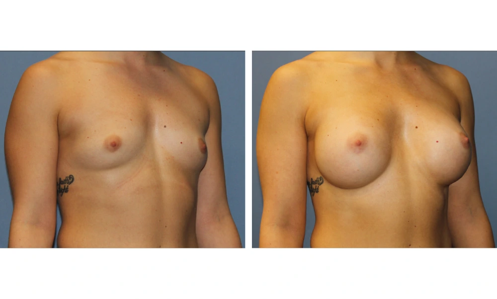 Breast augmentation before and after, three-quarter view