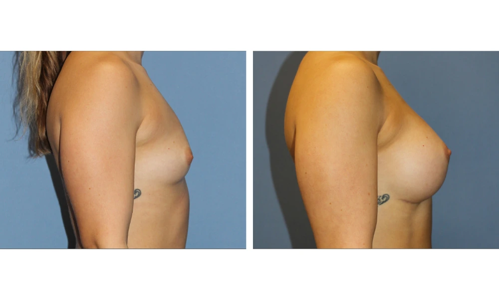 Breast augmentation before and after, side profile view