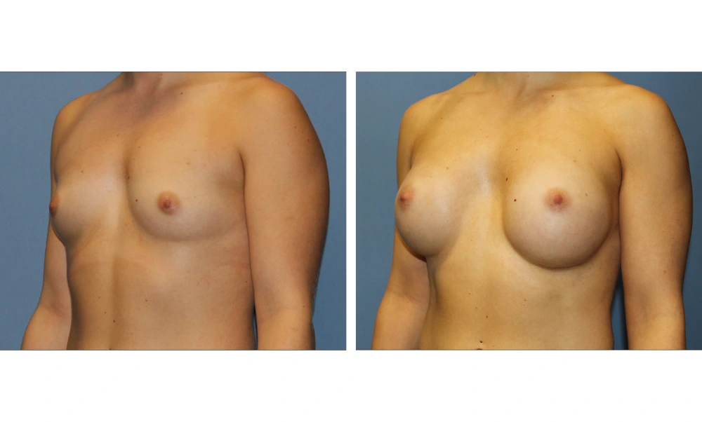 Breast augmentation before and after, front view, Case 22