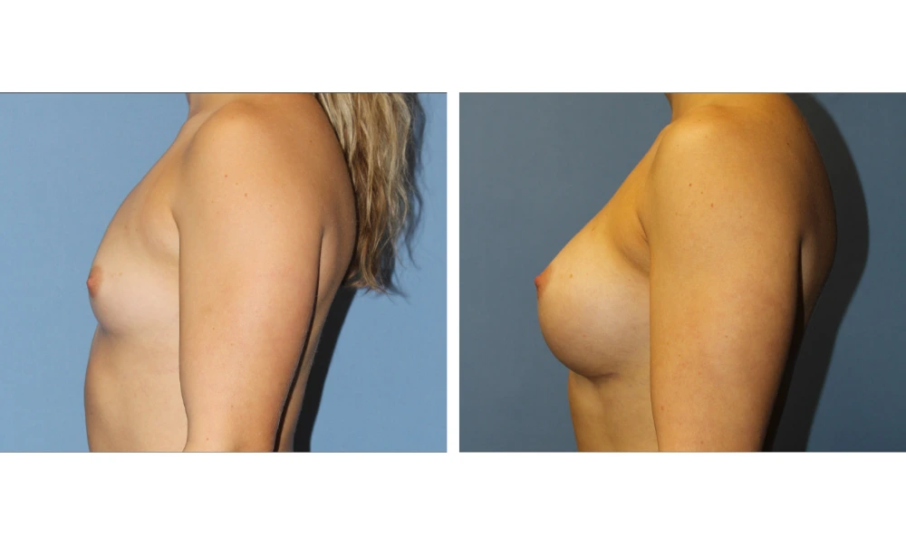 Breast augmentation before and after, side profile view