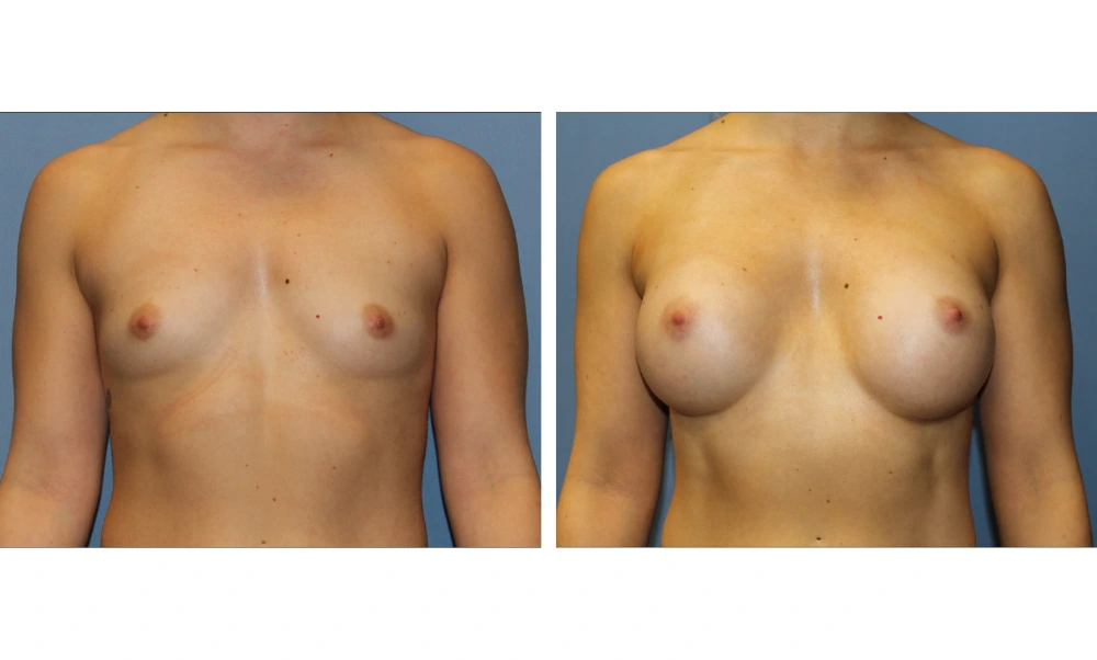 Breast augmentation before and after, front-facing view