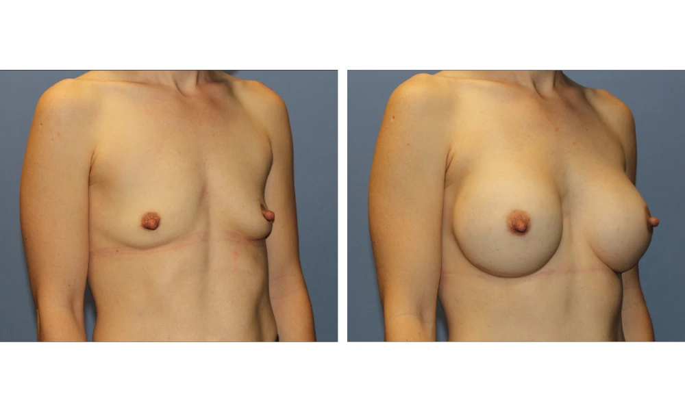 Breast Augmentation - Case 23 (2)