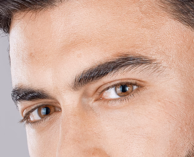 Brow Lift