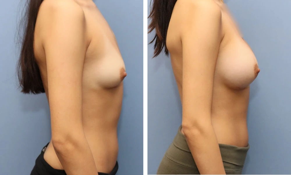 Before and after side profile breast comparison with longer hair visible