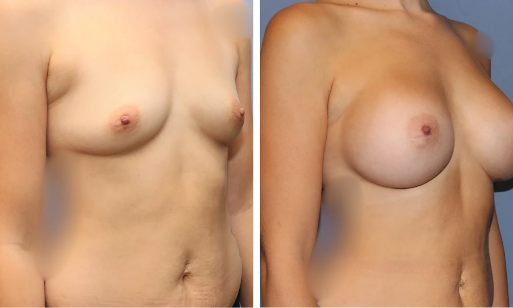 Breast augmentation before and after, side view
