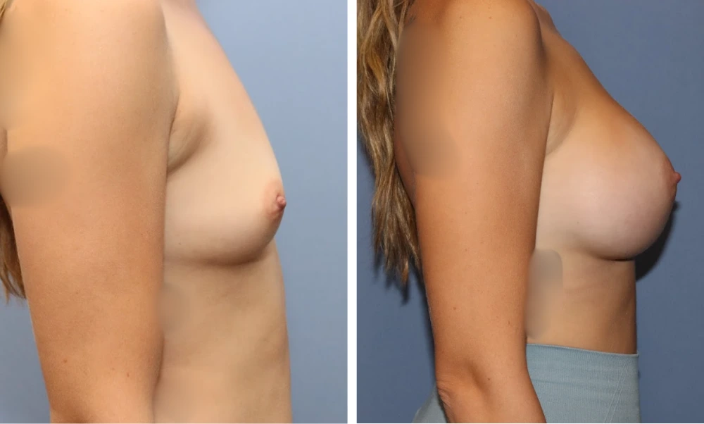 Before and after breast augmentation case showing side profile view with increased volume