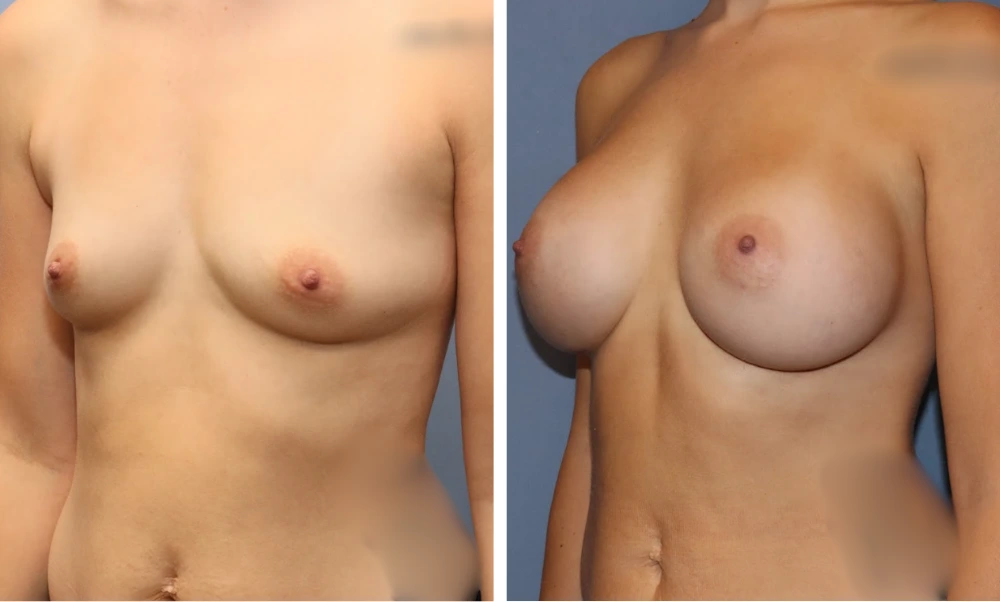 Breast augmentation before and after, oblique view