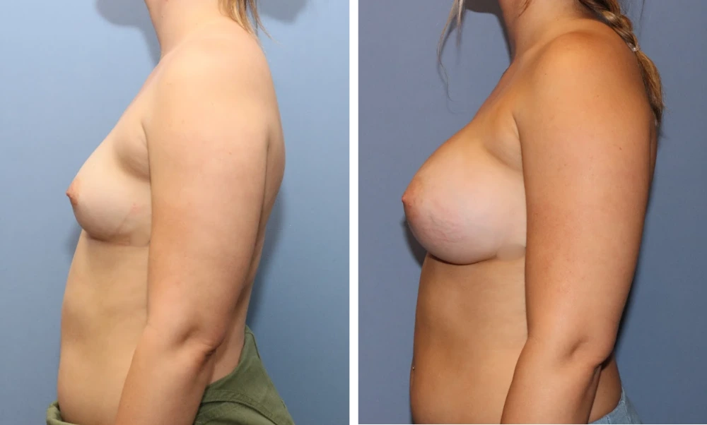 Before and after breast augmentation side profile view, demonstrating enhanced projection