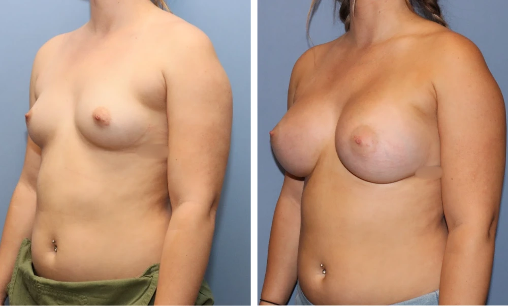 Before and after breast augmentation oblique view, showing improved contour and symmetry