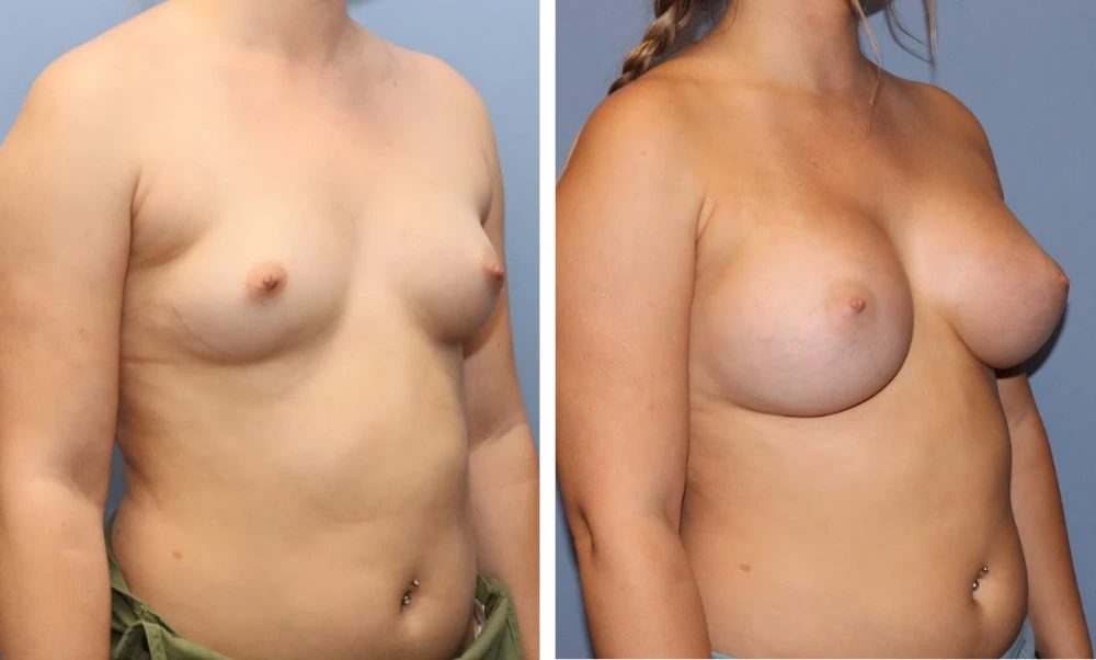 Before and after breast augmentation three-quarter view, displaying surgical results