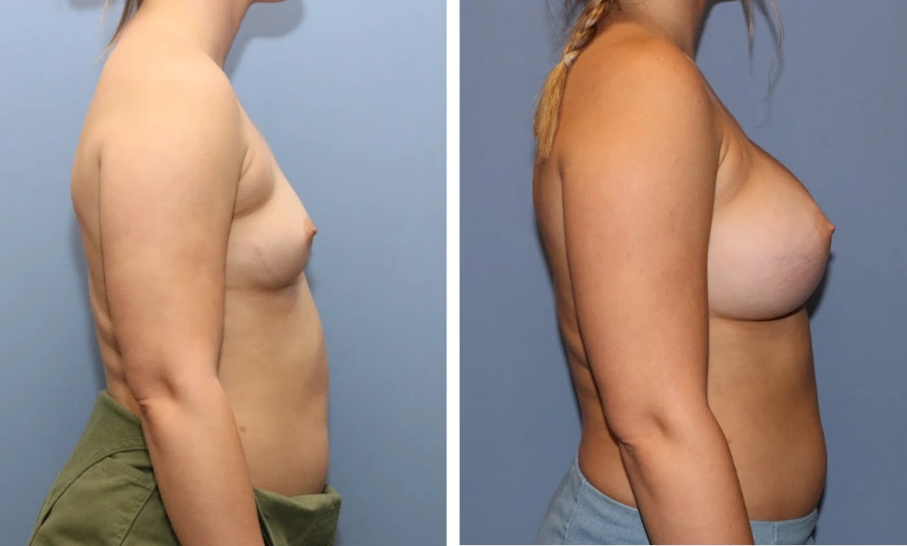 Before and after breast augmentation, side profile view showing improved contour and position