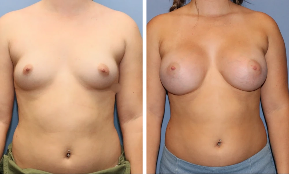 Before and after breast augmentation front view, showing increased volume and fullness