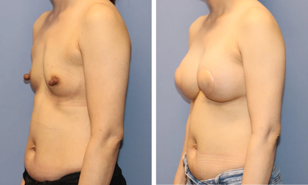Before and after breast augmentation, side view