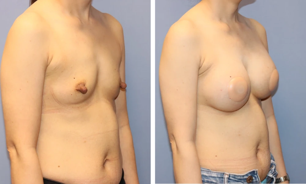 Before and after breast augmentation, frontal and side view