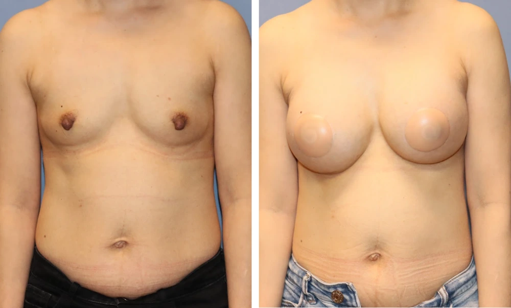 Before and after breast augmentation, frontal view