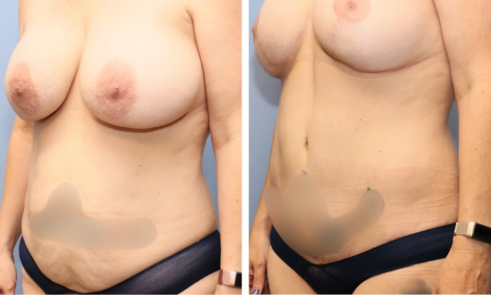 Before and after breast procedure case showing improved projection and symmetry