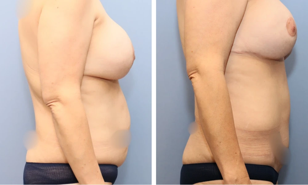 Before and after breast procedure case showing profile view with enhanced shape