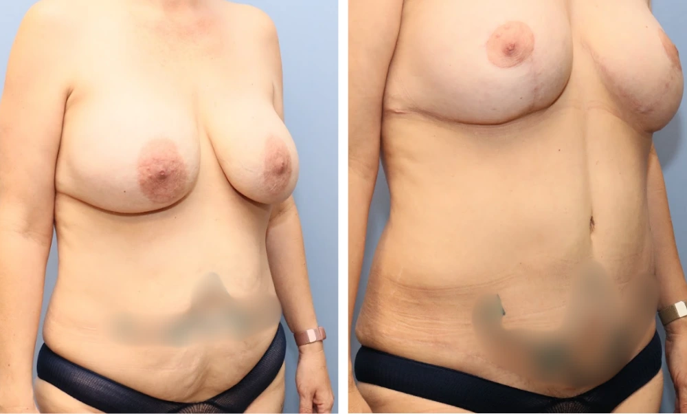 Before and after breast procedure case showing enhanced contour and positioning