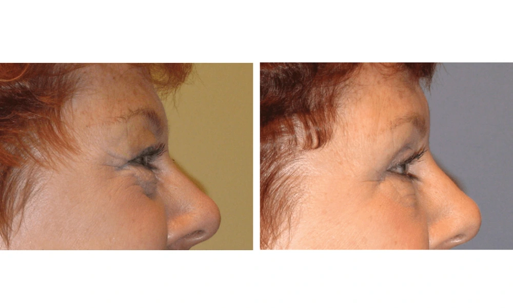 Eyelid Surgery (Blepharoplasty) - Case 1 (8)