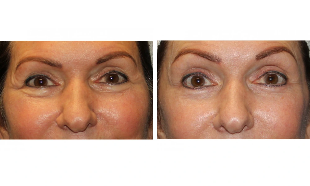 Eyelid Surgery (Blepharoplasty) - Case 8