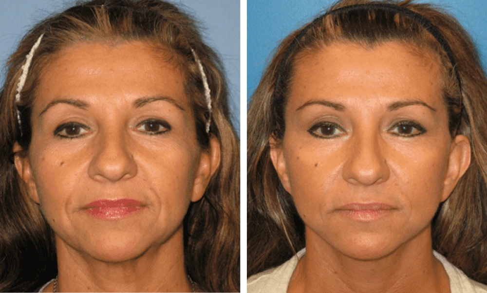 Face Lift - Case 5