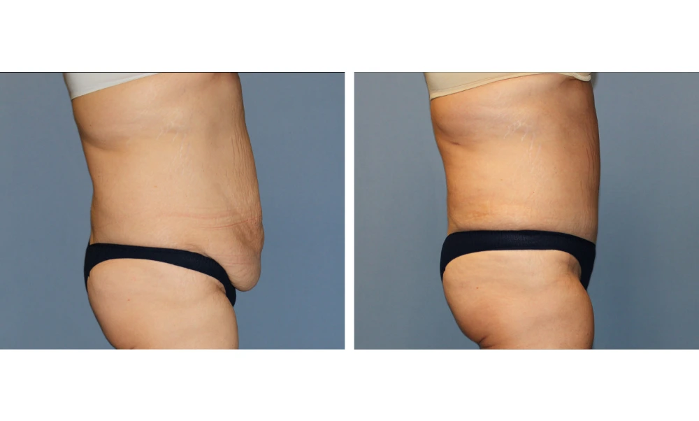 Before and after tummy tuck case 11, side view showing improved abdominal contour and skin tightness