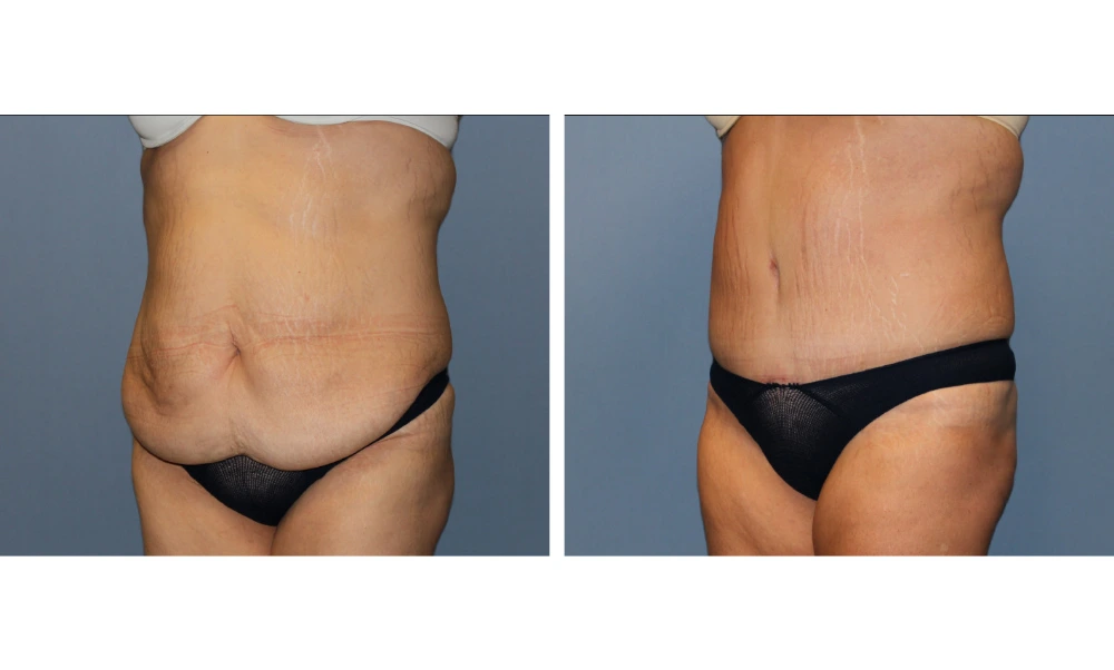 Before and after tummy tuck case 11, frontal view showing flattened abdomen and reduced skin laxity