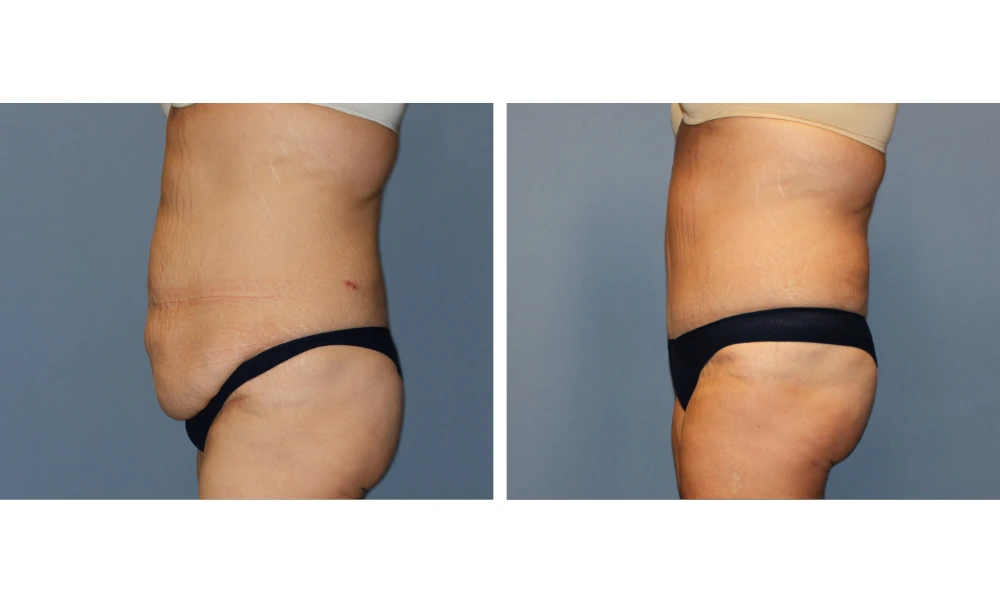 Before and after tummy tuck case 11, oblique view displaying improved midsection contour and skin firmness