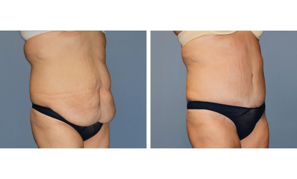 Before and after tummy tuck case 11, side view demonstrating reduced abdominal protrusion and skin tightening
