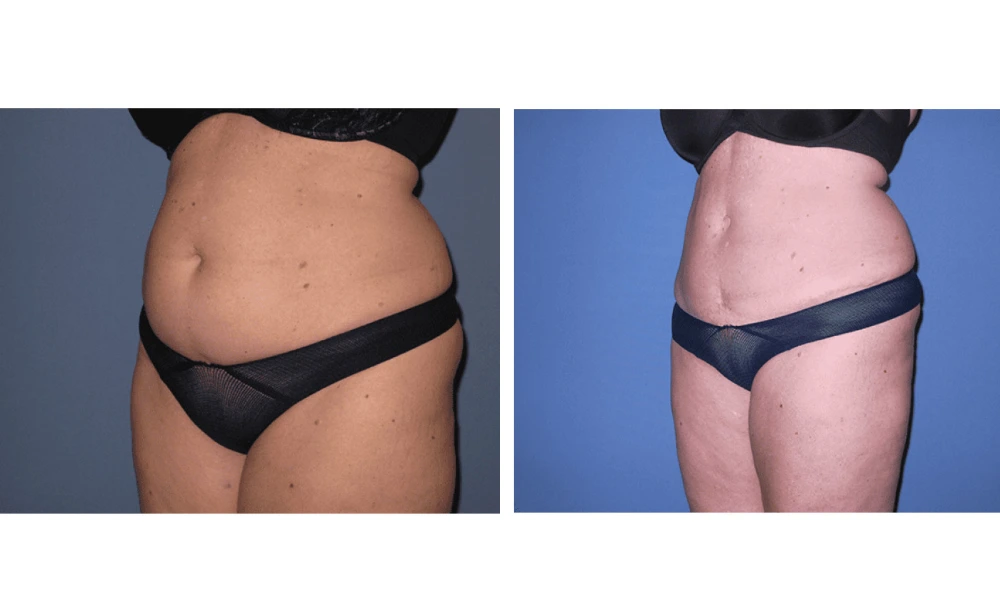 Tummy Tuck - Case 8 (3)
