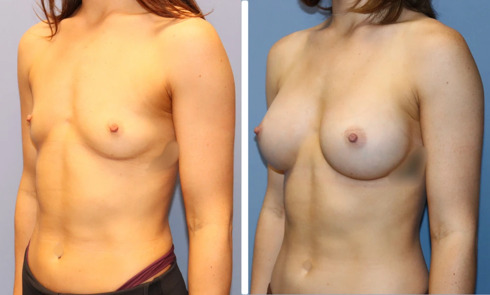 Before and after breast augmentation, three-quarter view