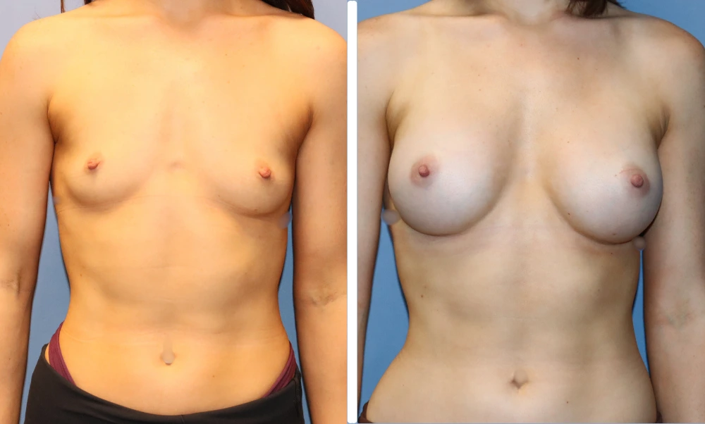 Before and after breast augmentation, frontal view