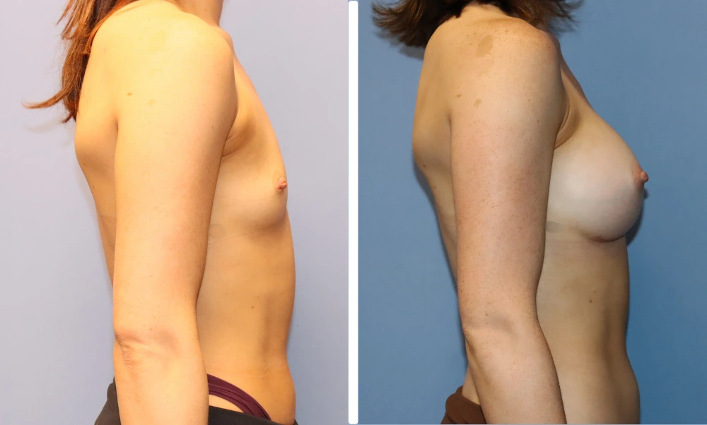 Before and after breast augmentation, side view