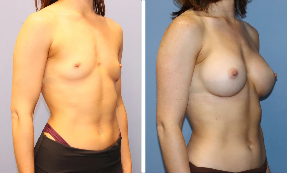 Before and after breast augmentation, oblique view
