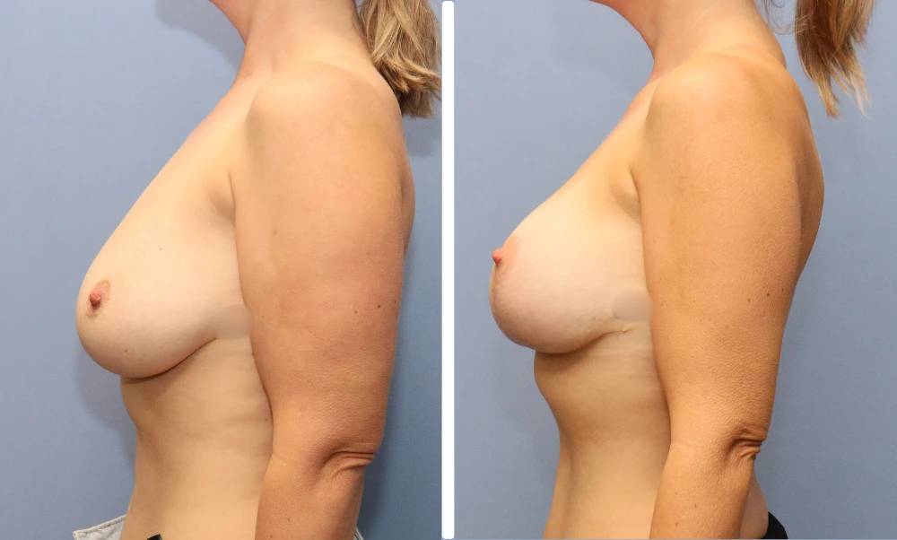 Before and after side view of breast augmentation results