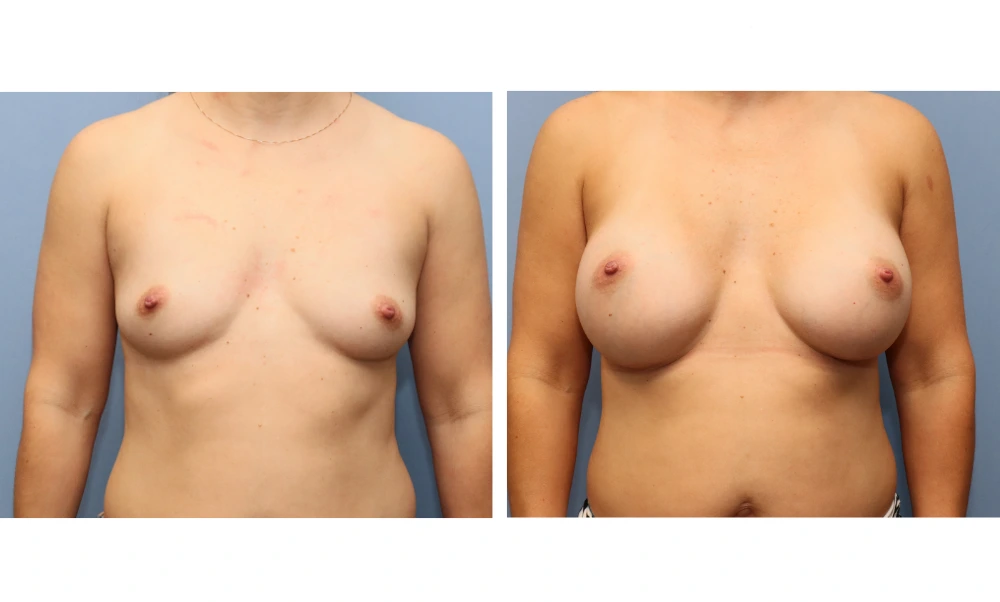 Breast augmentation before and after, frontal view showing increased size and lifted appearance