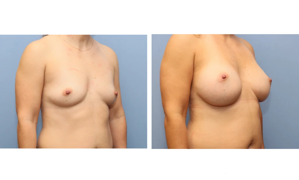 Breast augmentation before and after, frontal view demonstrating enhanced shape and contour